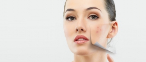 Tratamientos de control de acne