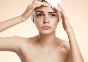 Tratamiento contra el acné, especialistas de la piel muy experimentados contra el acné